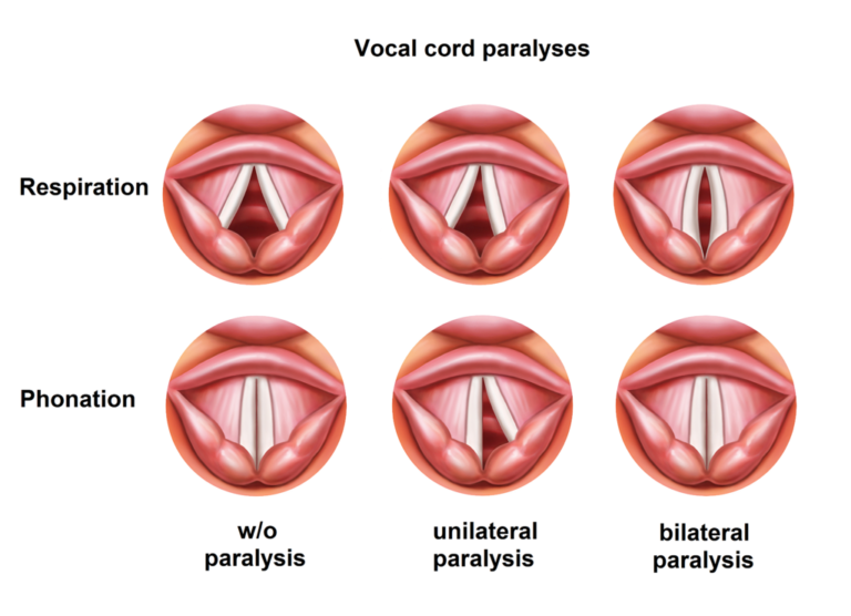 Vocalcorddysfunctions Vocal Cord Dysfunctions Information 8085
